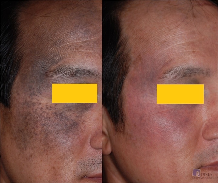 Nevus-of-Ota-Before--After